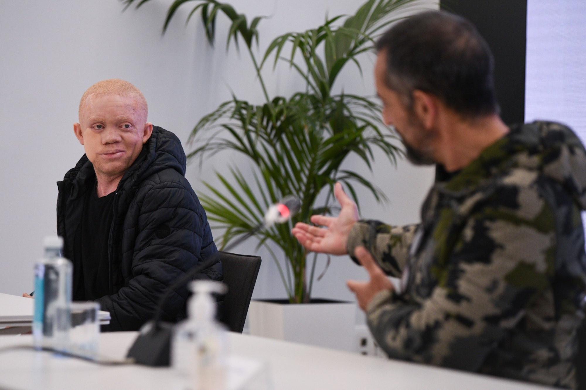 Cavadas reconstruye la cara a un paciente albino