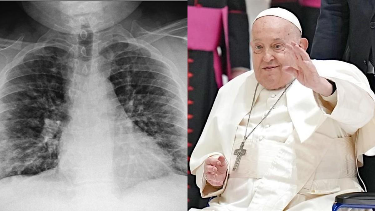 El Papa Francisco se ha visto afectado por una neumonía bilateral.