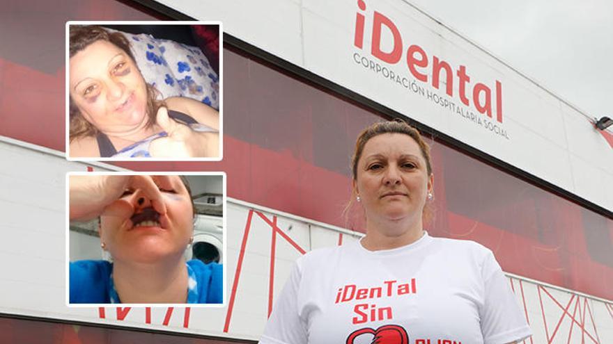 Mónica Merino, afectada de iDental en Gijón. En el recuadro, hematomas y secuelas que le quedaron tras la maratoniana intervención en la clínica dental de Tremañes.