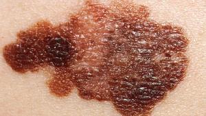 Imagen de un melanoma: el “tatuaje inteligente” abre una nueva vía para predecir el cáncer de piel antes de que sea visible.