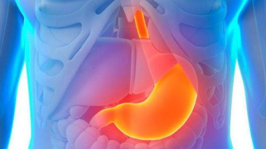 ¿Qué es la gastritis?