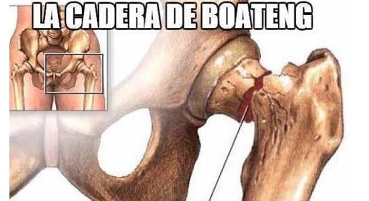Un mem sobre com ha quedat el maluc de Boateng després del regat de Messi. Un mem sobre com ha quedat el maluc de Boateng després del regat de Messi.