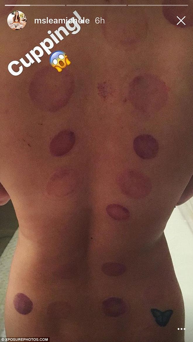 Lea Michele cupping 2