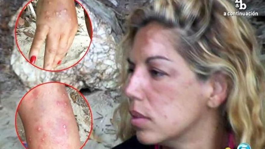 Rebeca, fuera de &#039;Supervivientes&#039; por picaduras de mosquitos