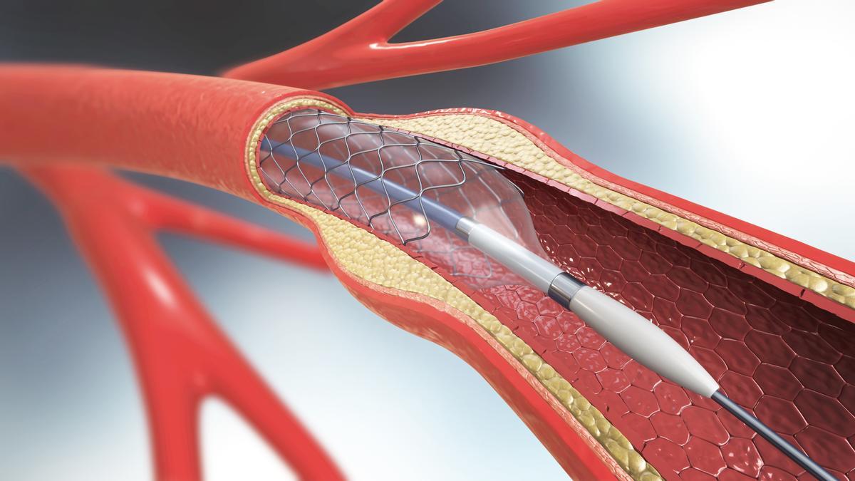 Angioplastie mit aufblasbarem Katheter.