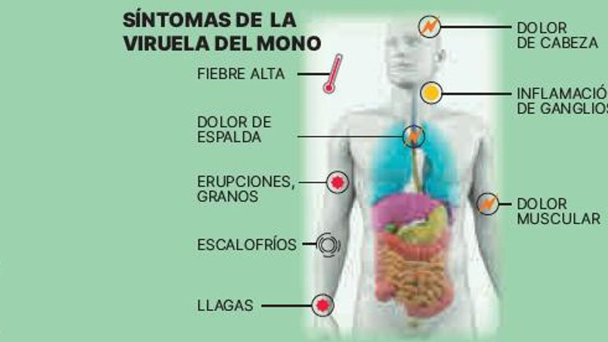 Canarias detecta un segundo caso sospechoso de viruela del mono 