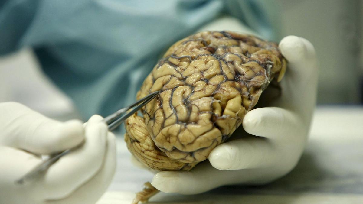 Imagen de un cerebro humano enfermo de Alzheimer.