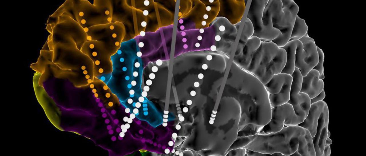 Electrodos de implantación profunda múltiple. | SCIENCE