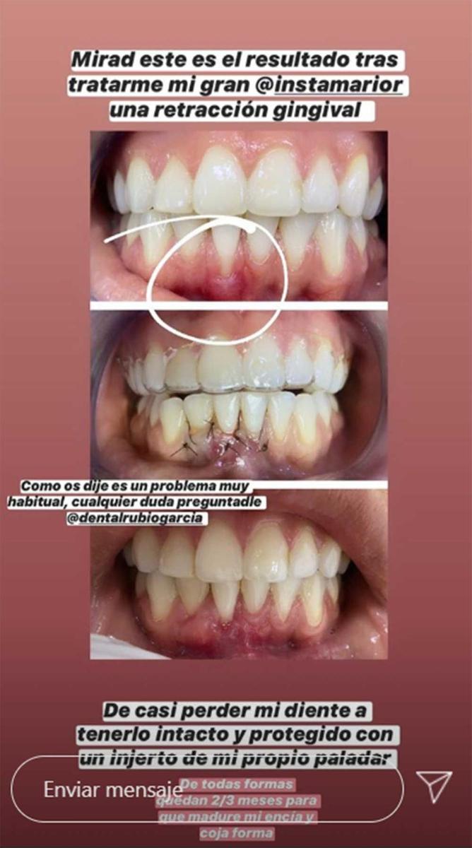 Proceso dental al que se ha sometido Sofía Suescun