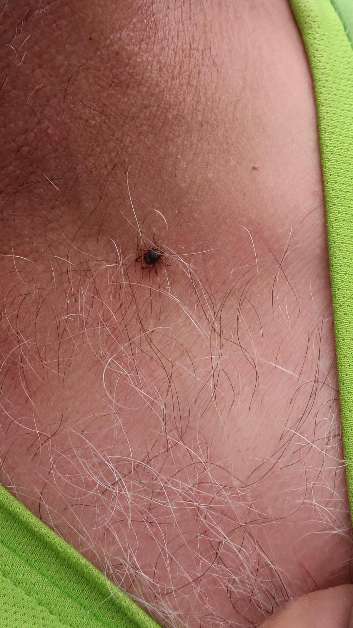 Una garrapata avanza por el cuello de un agricultor de Sumacàrcer.
