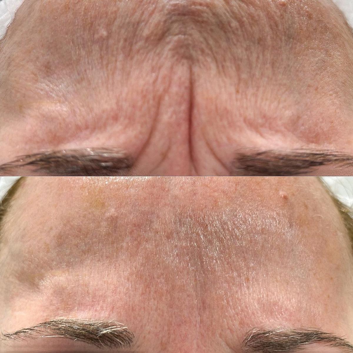 El antes y el después de un tratamiento para corregir las líneas de expresión de la frente.