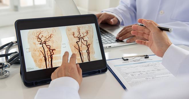 Омбудсмен Каталонии расследует доступность тромбоэктомии для инсультников