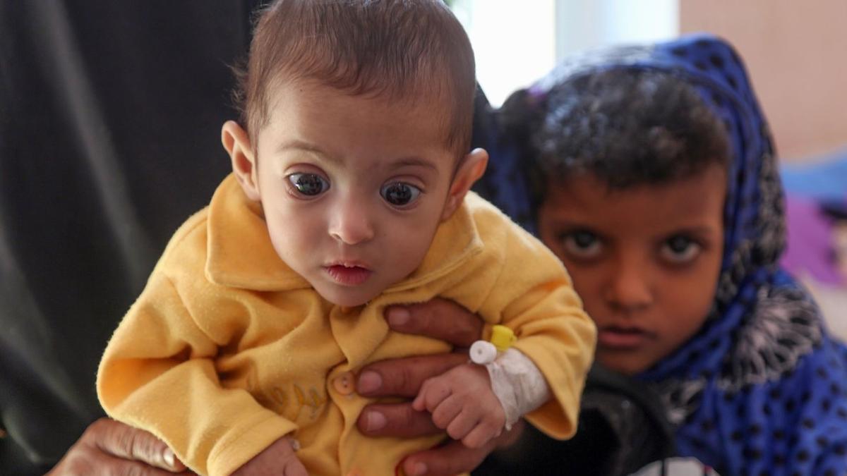 Una mujer aguanta un niño malnutrido en un centro sanitario en la ciudad de Taiz, Yemen.