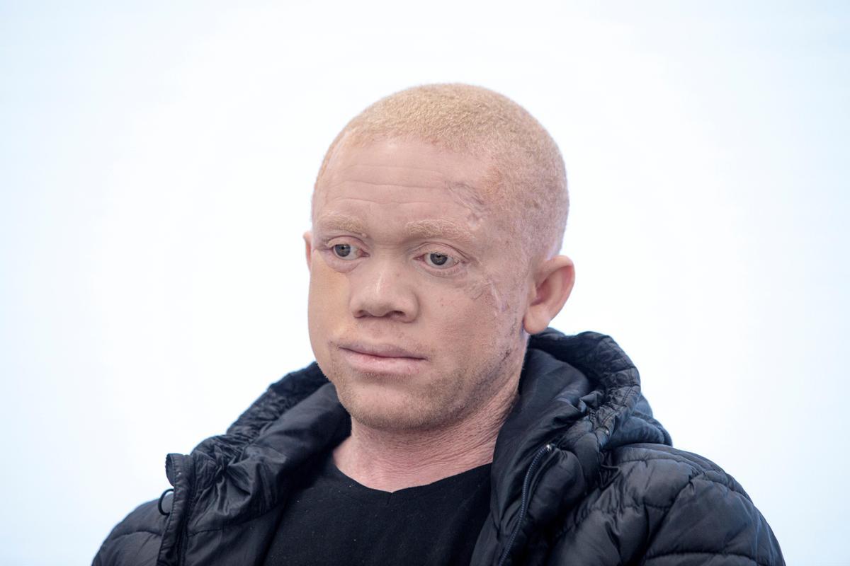 Cavadas reconstruye la cara a un paciente albino