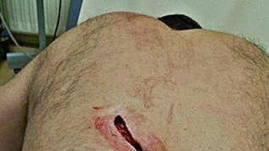 Algunas de las heridas sufridas por Pedro Santos en la espalda.