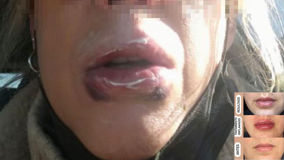 Imagen de una de las pacientes dañadas después de someterse al tratamiento en una de las clínicas investigadas. Derecha, uno de los anuncios de las clínicas.