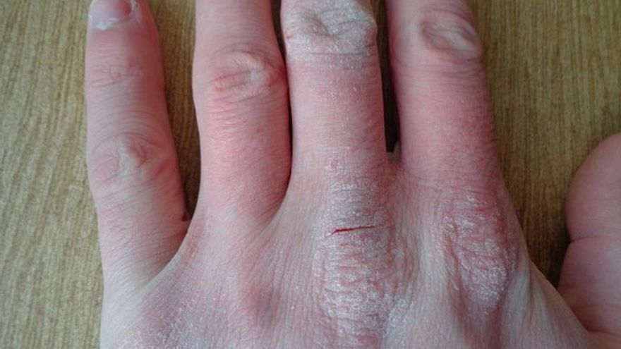 Nuevo fármaco para el parkinson