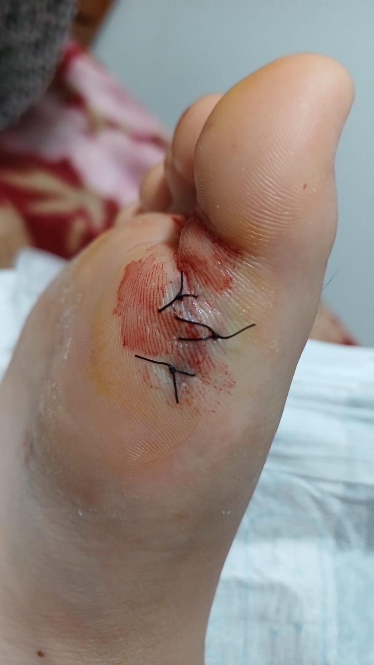 Otra de las niñas que sufrieron un corte profundo en la piscina de Samil, por el que recibió tres puntos de sutura.