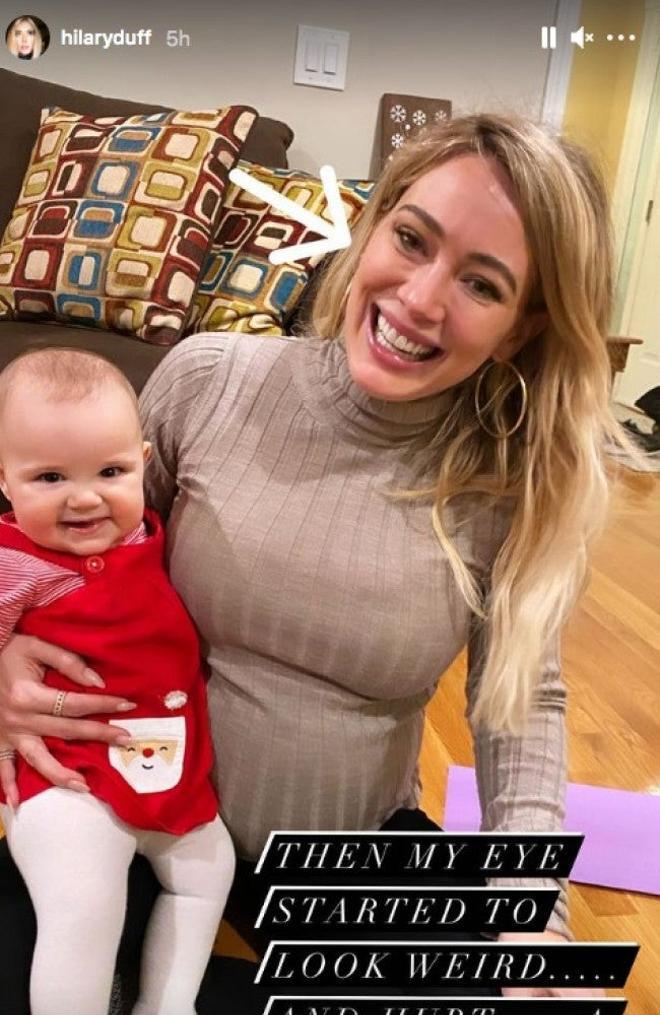 Hilary Duff habla sobre su infección en el ojo