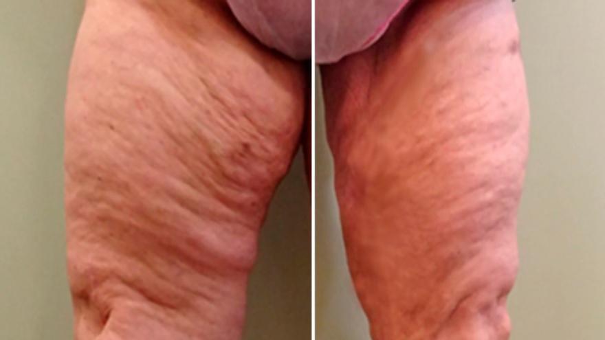 LIPEDEMA 2