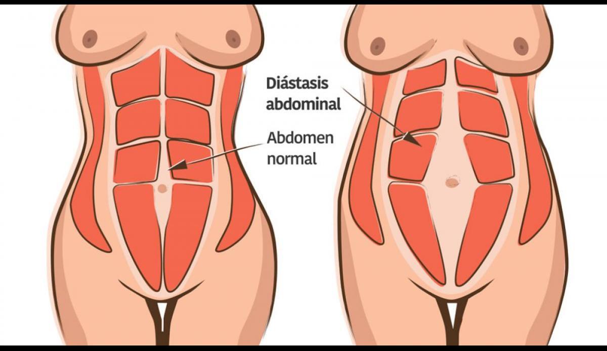 La diástasis de rectos abdominales (DRA) podría aparecer en cualquiera de nosotros por diferentes razones como cirugías, problemas pulmonares u obesidad.