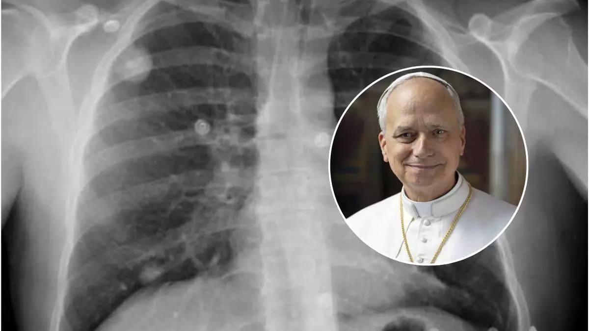 Así es un nódulo pulmonar, la lesión por la que el papa León XIV tiene que pasar por quirófano
