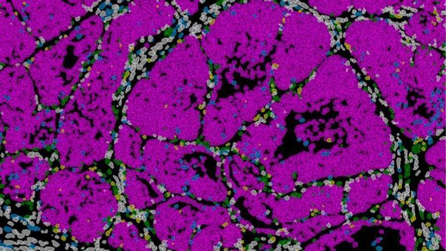 Prrx1, así es el gen que determina si las células de cáncer de mama forman metástasis o permanecen 'dormidas'