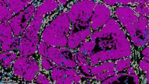 Tumor de mama en ratón con células cancerosas (rosa)