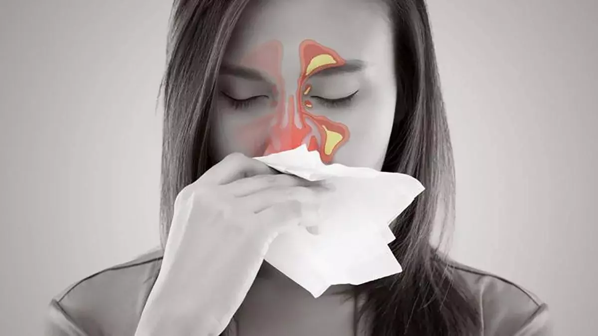 La sinusitis es la inflamación de los senos paranasales producida por un proceso catarral