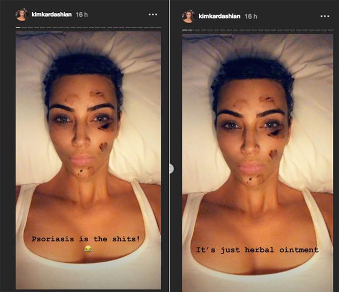 Kim Kardashian trata su psoriasis