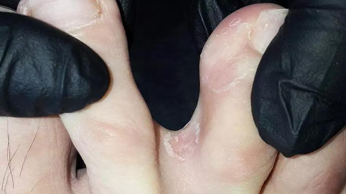 El peu d'atleta és una de les infeccions dels peus més freqüents.