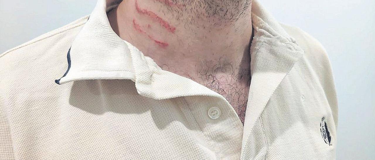 Uno de los funcionarios agredidos en Villena, con lesiones en el cuello