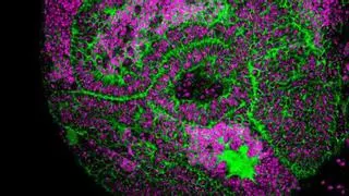 Un estudio detecta dos genes "esenciales" en el desarrollo de tumores cerebrales