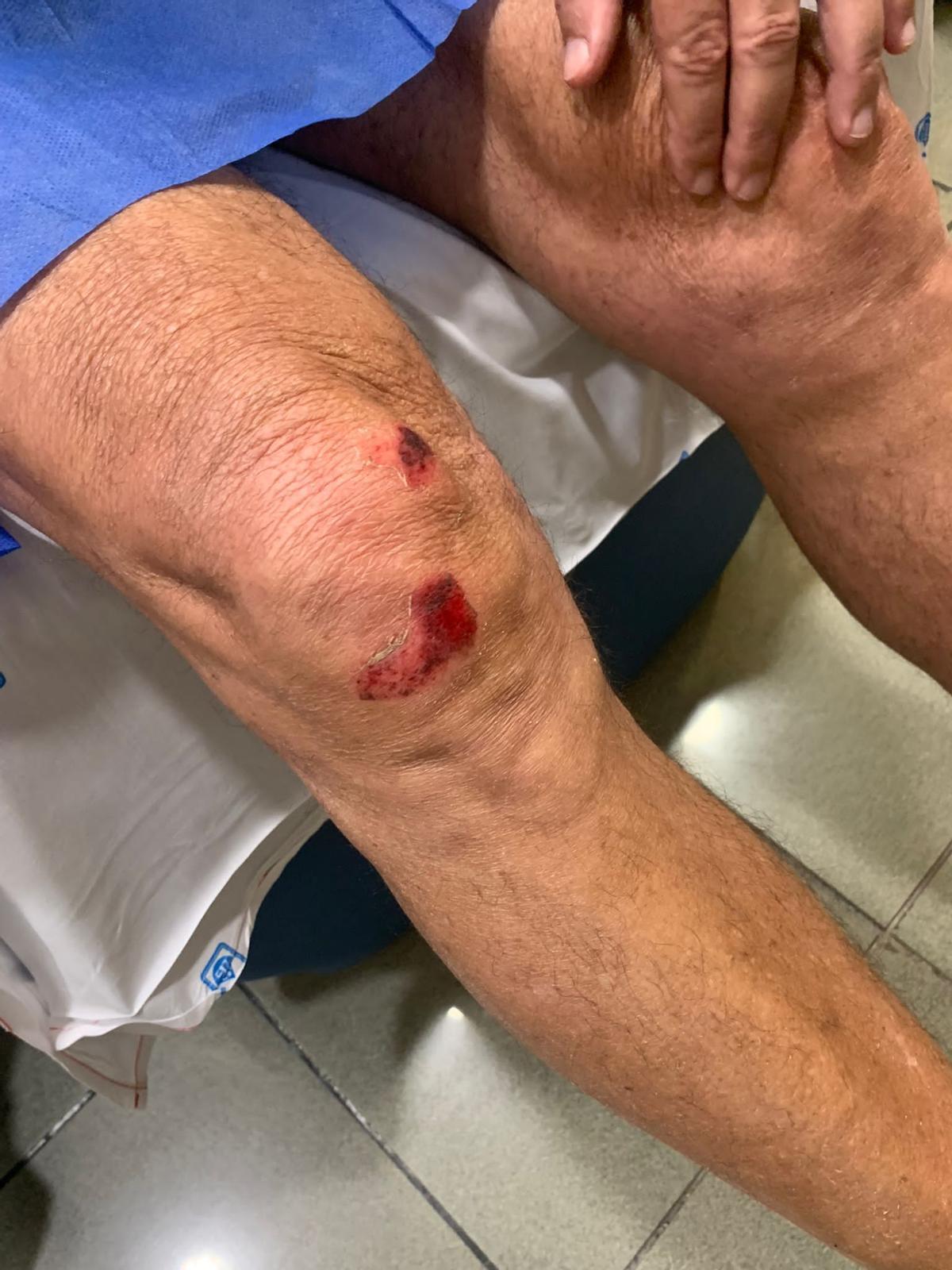 Un turista canario del Imserso muestra su herida en una rodilla tras ser agredido en Barcelona.