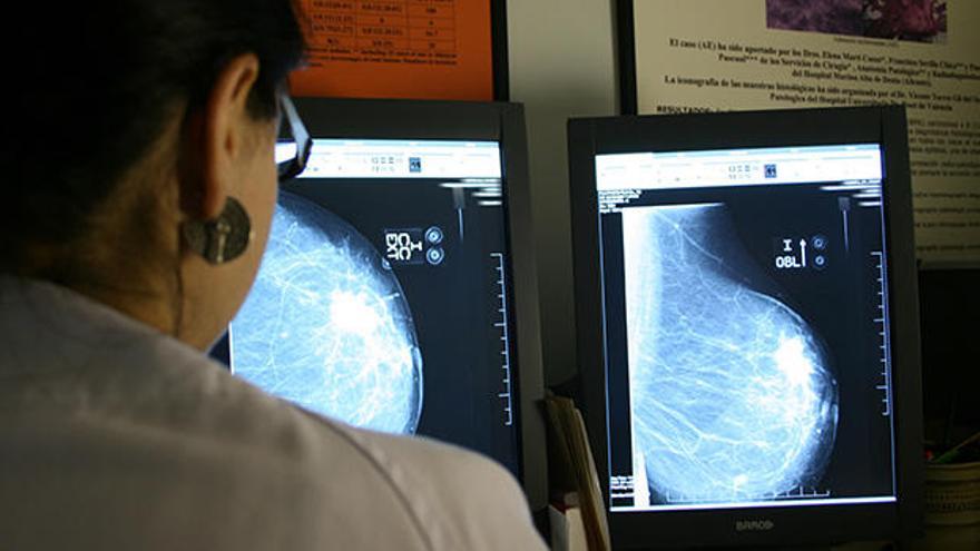 La supervivencia a los 5 años del diagnóstico de cáncer de mama en la Comunitat Valenciana es del 85%