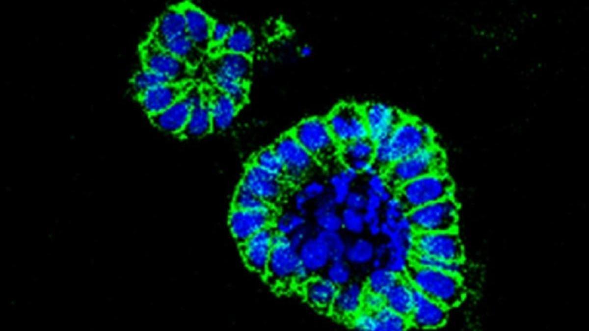 Organoide de cáncer de colon.