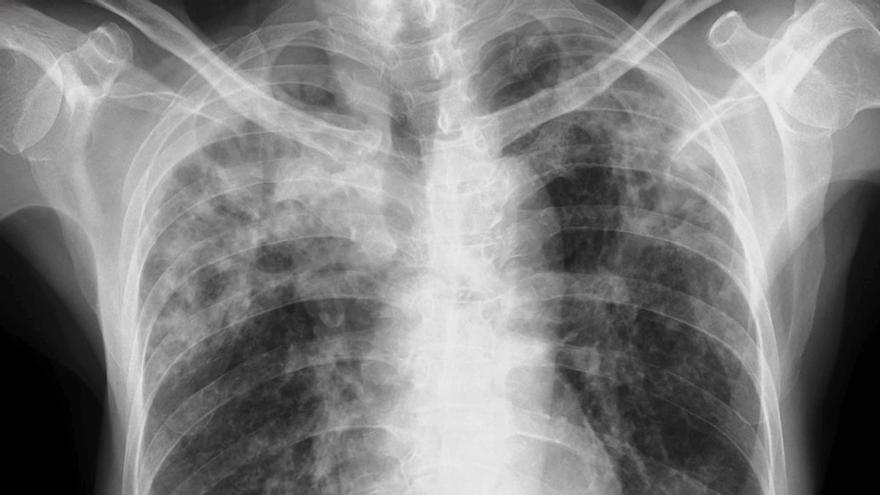 Radiografía de un paciente con tuberculosis.