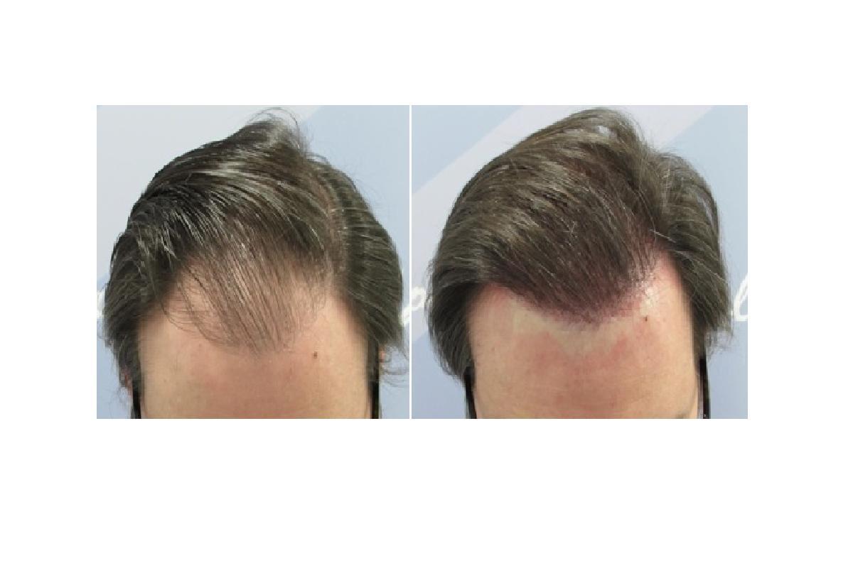 Una técnica que no necesita rasurado y que implanta pelo ya largo.