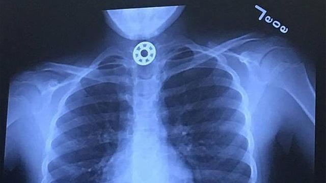 Imagen de la radiografía realizada a la niña.