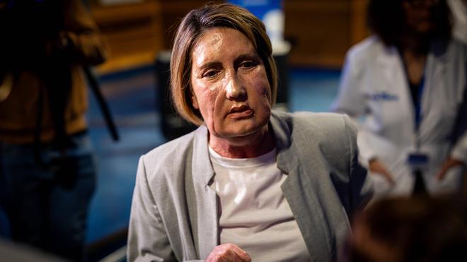 Primer trasplante de cara del mundo con una donante fallecida por eutanasia