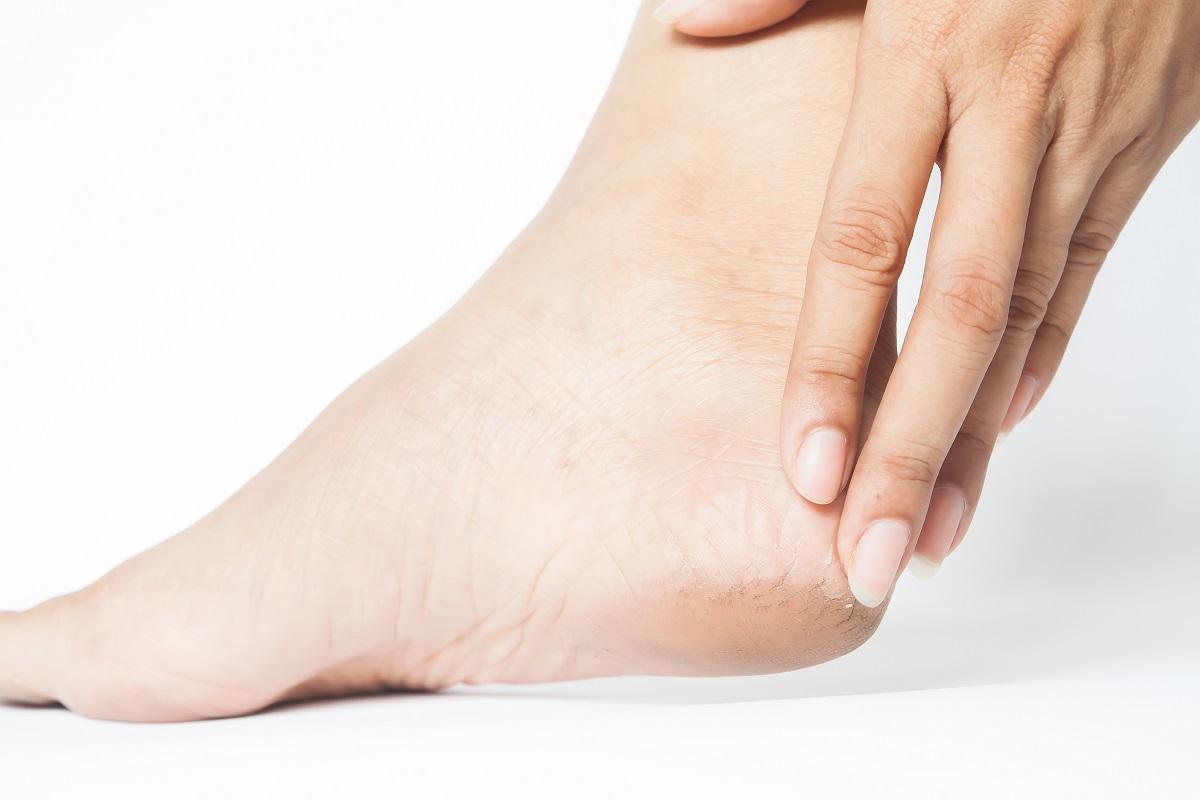 El calor provoca la aparición de grietas en los pies, sobre todo en los talones.