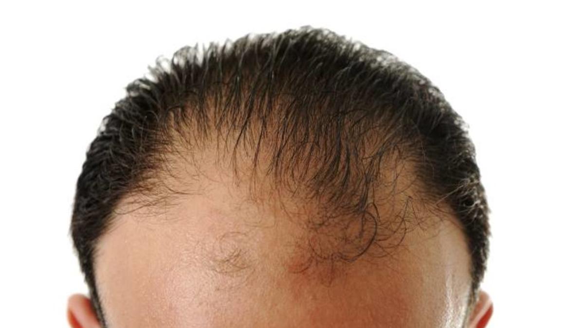 alopecia