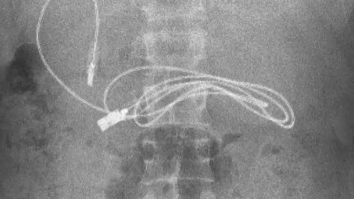 Descubren que tenía un cable USB en el estómago: &quot;Un extremo había pasado al intestino&quot;