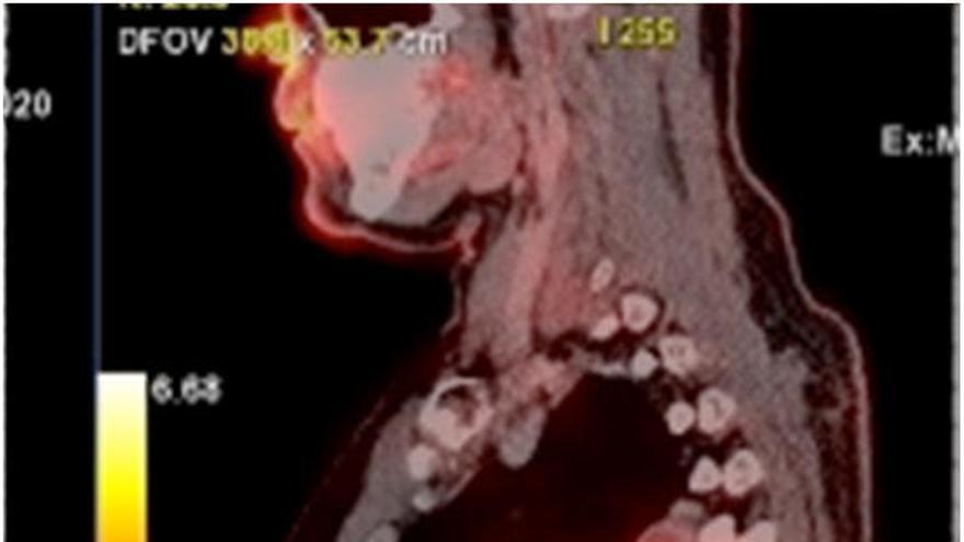 Estudio PET-TC donde se aprecia el tamaño de la lesión y el desplazamiento de las estructuras del mediastino, corazón, esófago, carina y vasos pulmonares así como al pulmón derecho. Afecta a las costillas de la pared costal a tres niveles.