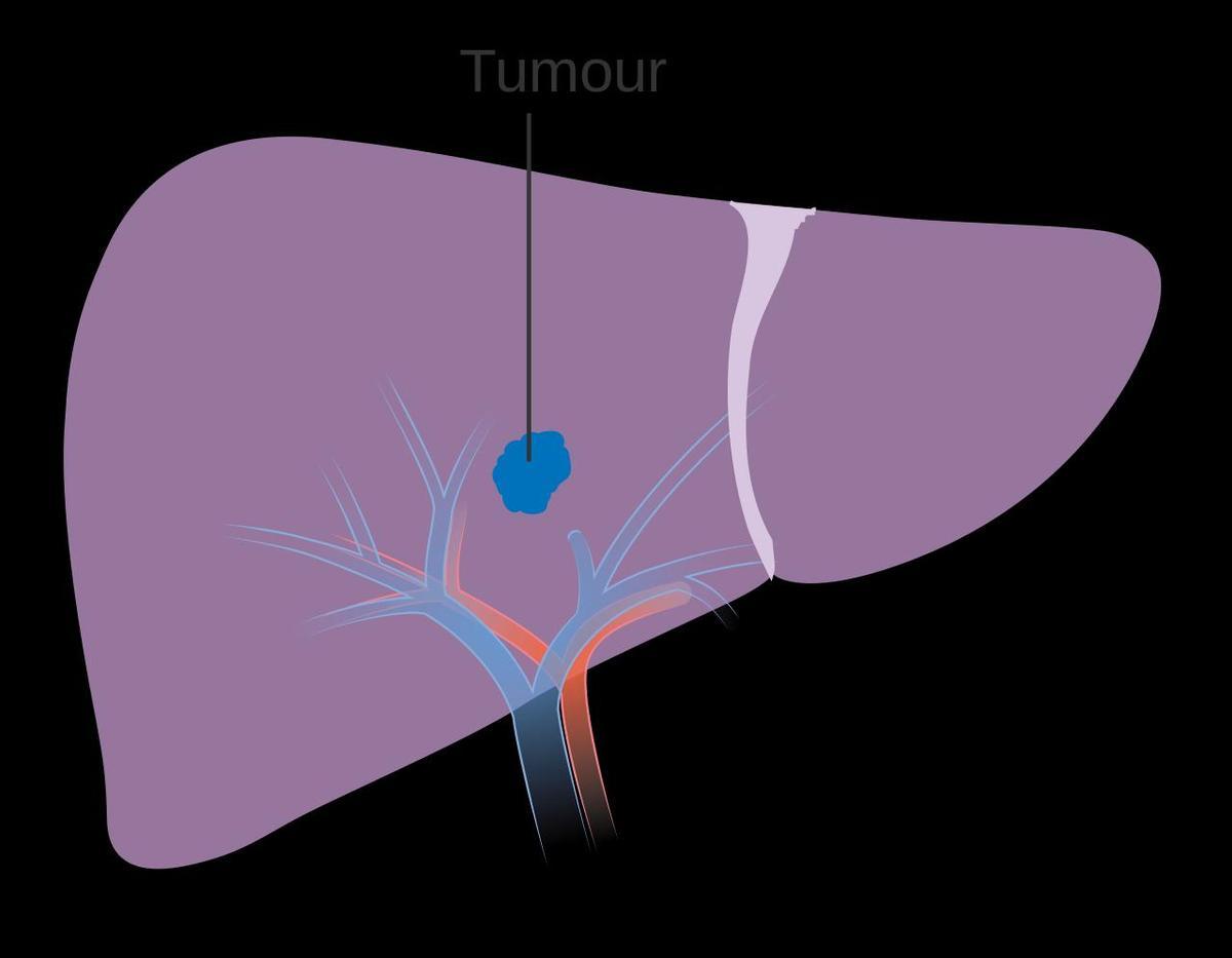 Diagrama de un carcinoma de higado en estado 1