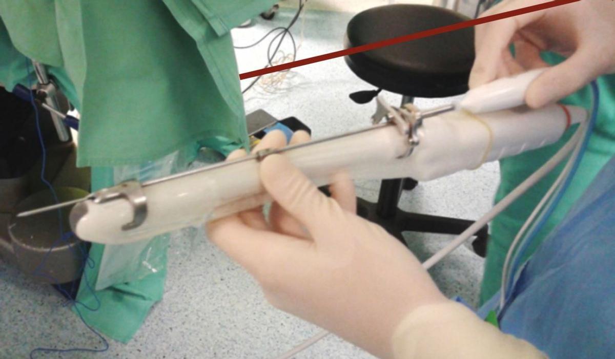 Aparato de radiofrecuencia para miomas.