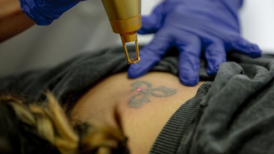 La eliminación de tatuajes está en auge