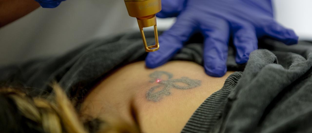 La eliminación de tatuajes está en auge