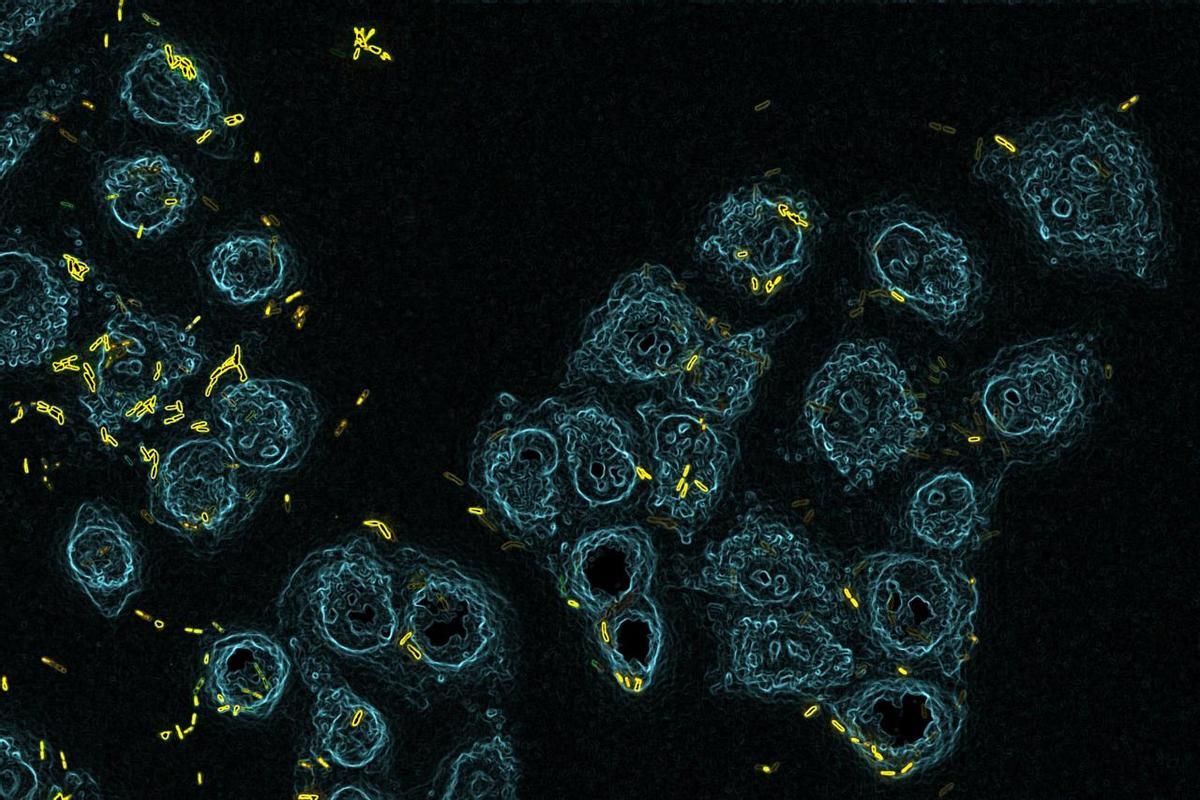 La bacteria patógena Pseudomonas aeruginosa (amarillo) infecta y mata un cultivo celular de células epiteliales pulmonares (azul).