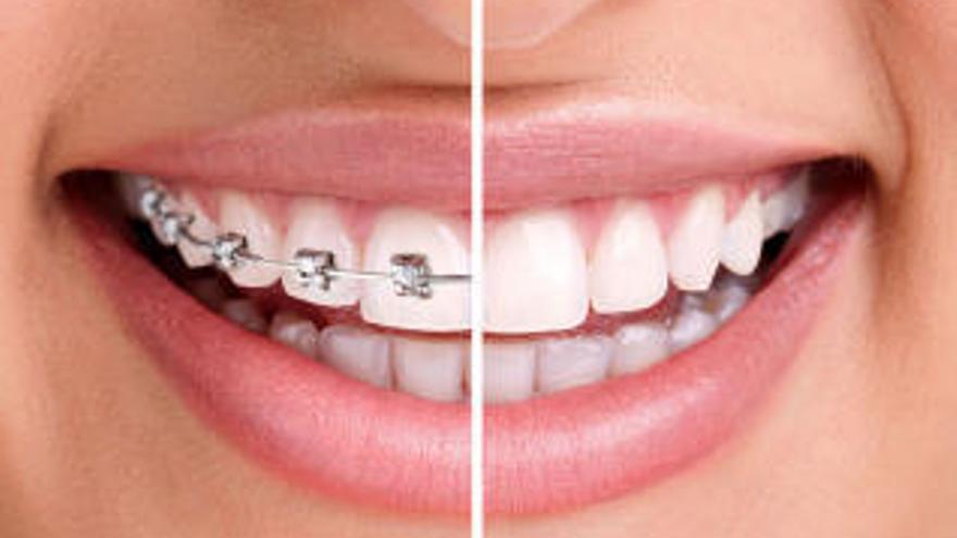 Invisalign, la clara alternativa a los brackets